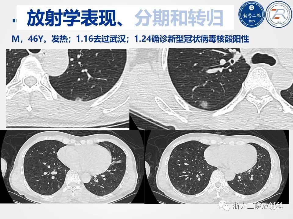 心型冠状肺炎最新动态与概述，最新消息及全面解析