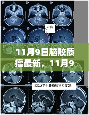 脑胶质瘤最新进展，自信之光照亮希望之路（11月9日更新）