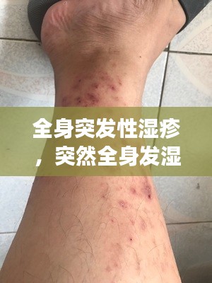 全身突发性湿疹，突然全身发湿疹什么原因 